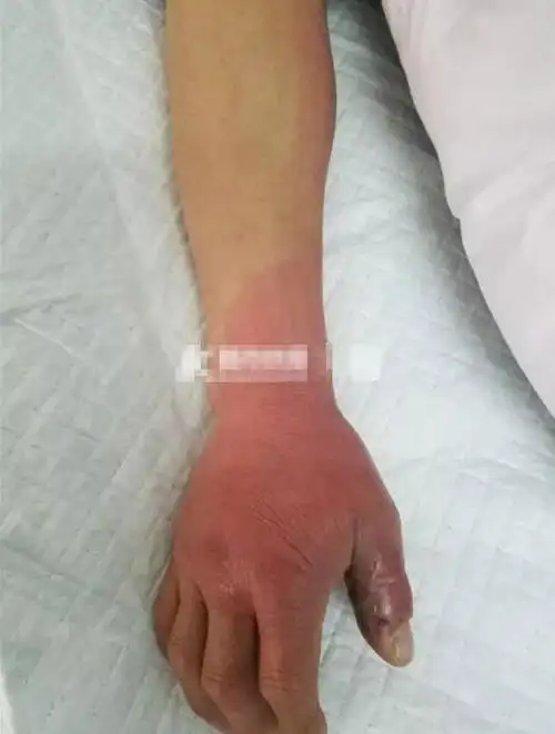 男子被眼镜蛇咬伤自己挤出毒血后不就医隔天伤口红肿头晕胸闷