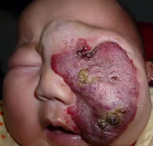 血管瘤的并发症包括:溃疡(皮肤破溃)导致出血或感染,重要器官功能的