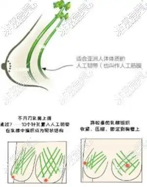 胸下垂松弛手术多少钱能矫正提升收费按乳房下垂程度