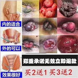 痣疮膏特效消肉球正品成人男女产后草本断痔内外混合止痒痔痔药膏