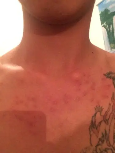 胸口都是红色的疙瘩. 是什么原因阿?