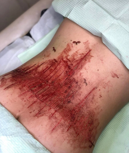 背部哥特城堡肉雕纹身割皮纹身及恢复后图片7