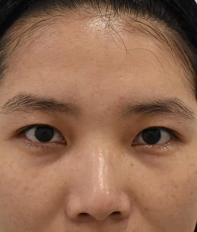 沟,它是由于眼眶隔膜下缘的软组织萎缩下垂而生成的,有的人甚至可以延