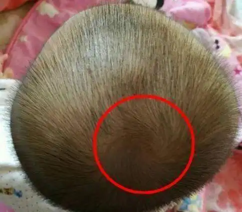 每个宝宝脑袋上都会长"旋",你知道这些"旋"分别代表什么吗?