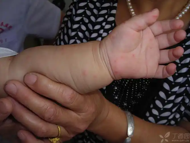 【讨论】手足口病的皮疹分布发生了变化,诊断时要注意. [病例帖]