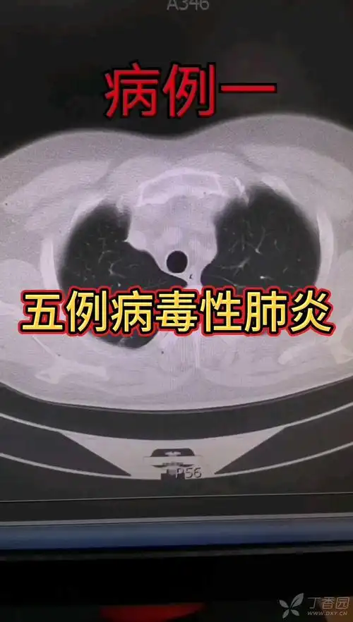 五例病毒性肺炎ct影像学表现大家看看都有什么影像征象