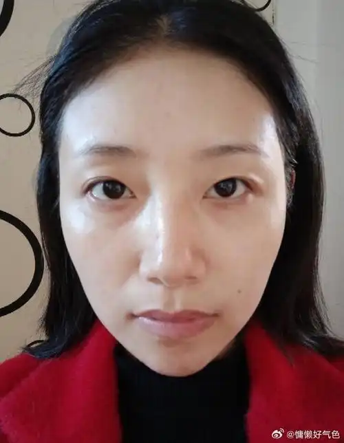 不过,她的眼眶和面中部的凹陷问题较为明显,导致出现了泪沟和法令纹.