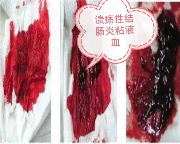 谈谈疫情下,哪些便血情况可以在家自己处理,如何处理.