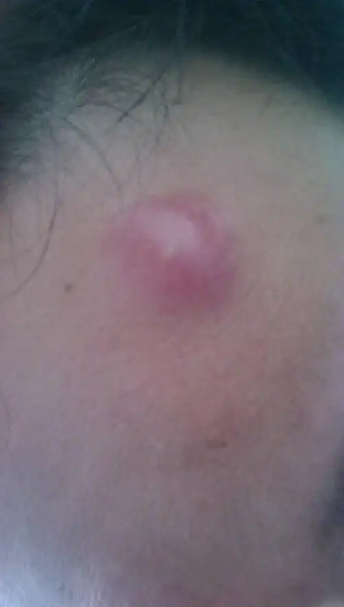 额头上长了个大包,到底是什么东东?