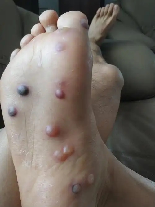 足底跖疣治疗过程