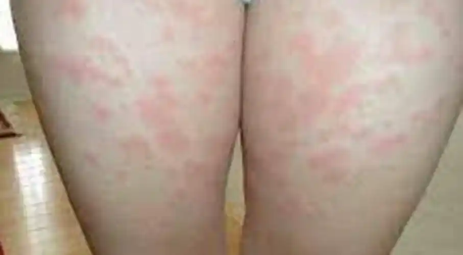 艾滋病初期指甲盖症状图片