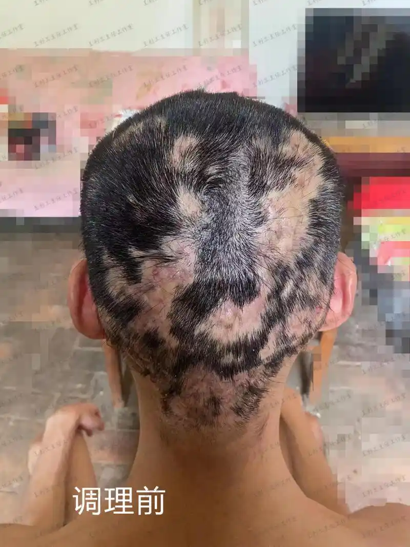 穿掘性毛囊炎伴脱发,三个月炎症消退,小伙长出头发了!