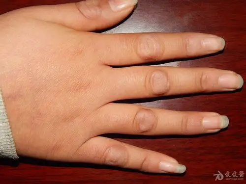 小女孩的手指节垫