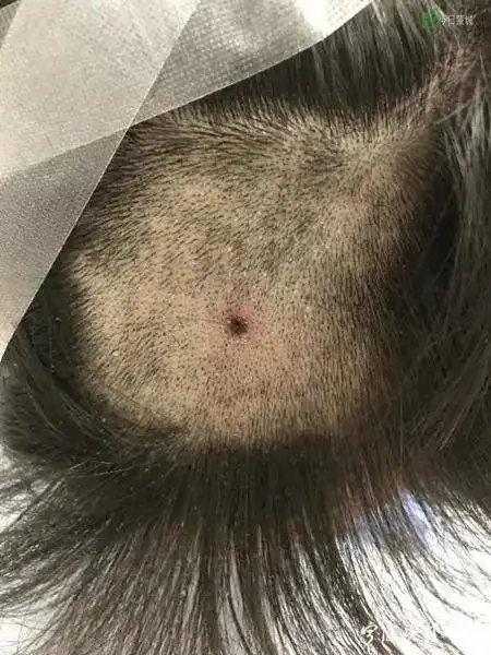一位患者头部残留的蜱虫,图据宁波晚报