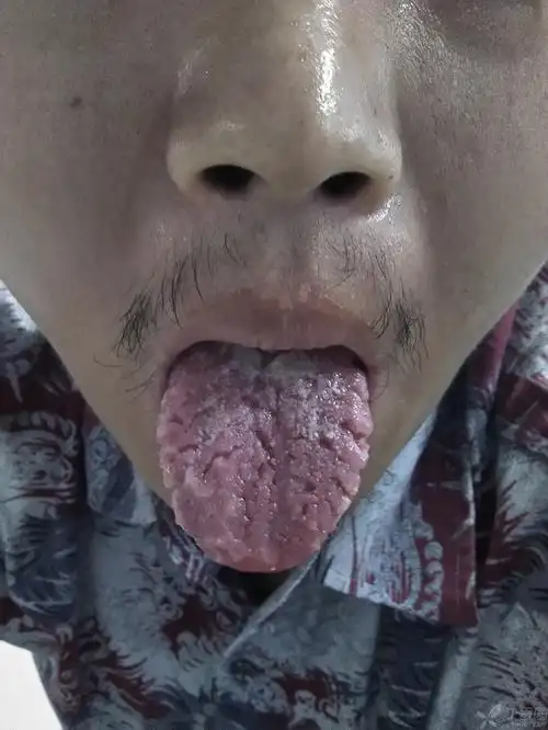 【原创】裂纹舌