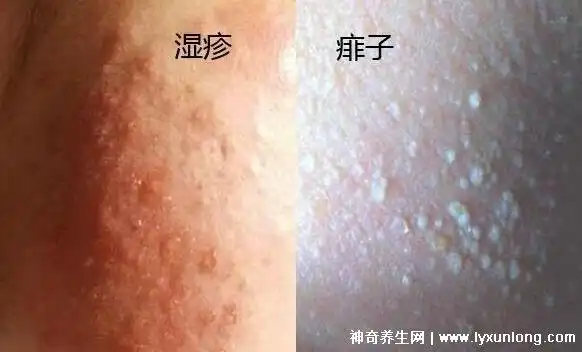 分为白痱子,红痱子,脓痱子三种,一般在丘疹的顶端有发白的小尖.