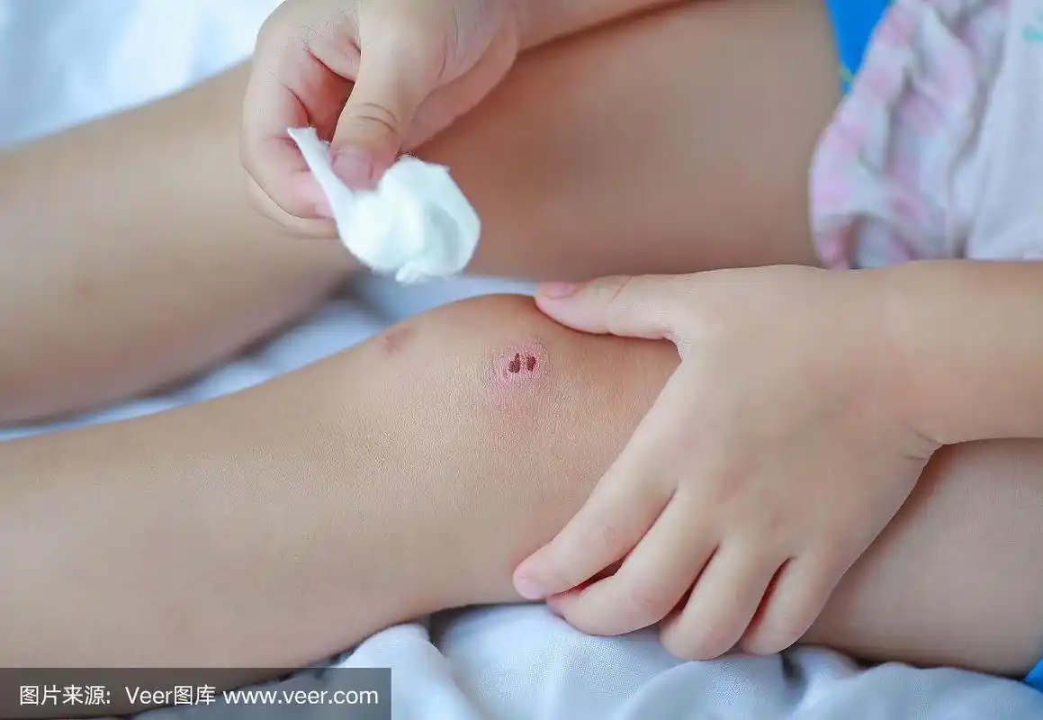 近距离拍摄女孩在床上自己包扎膝盖上的伤口.