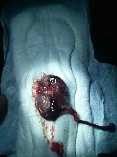 子宫内膜脱落是好是坏