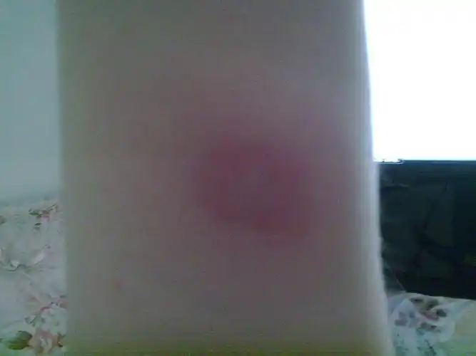 我用尺自己量了一下红晕及硬节:1.8*1.4左右,请问这是什么性质