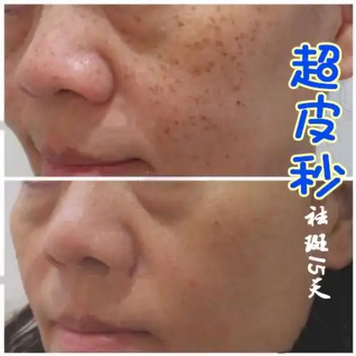 对比了几家超皮秒祛斑,这家的还算划算,刚做完即刻就_圈子-新氧美容