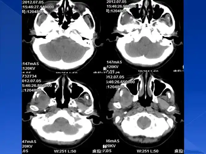 颞下窝炎性假瘤.ppt
