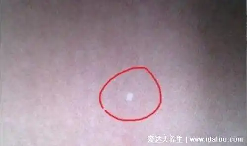 小孩肚子上有块白斑图,有五种可能不一定是白癜风导致