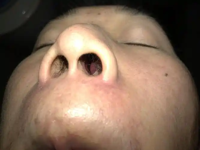 左测鼻子里红肿 有感冒流鼻涕