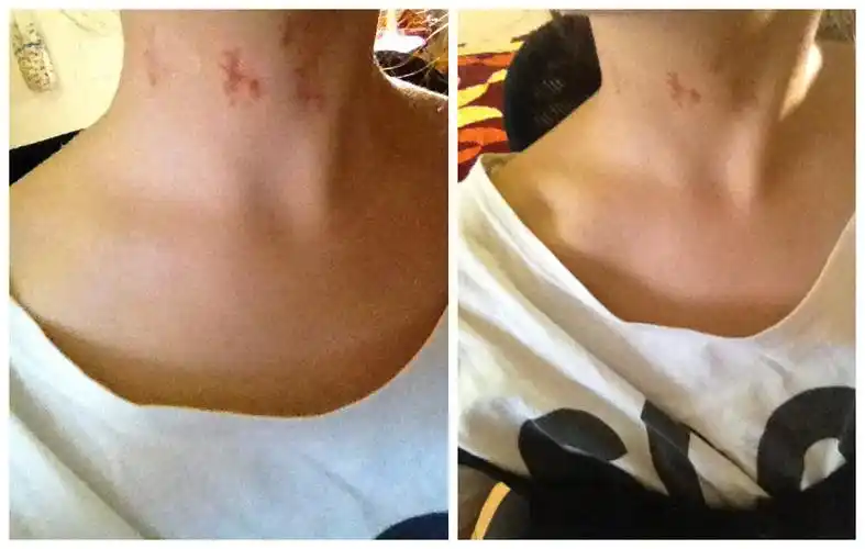 脖子上的吻痕_脖子上的吻痕叫什么