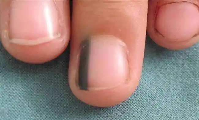 指甲上有一条黑色是癌症吗