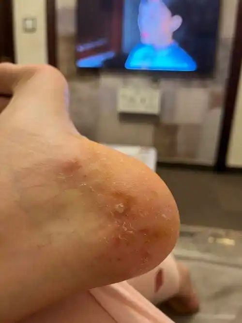 原创脚上起了好多小水泡一样的东西很痒是怎么回事