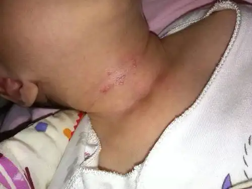 问:宝宝脖子上出了脓疱疹,这个要怎么治啊