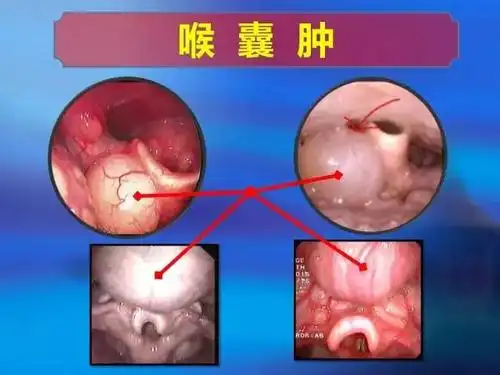 的上方甚至偏左侧偏右侧,在舌根部呢,喉镜检查会发现小朋友长喉囊肿