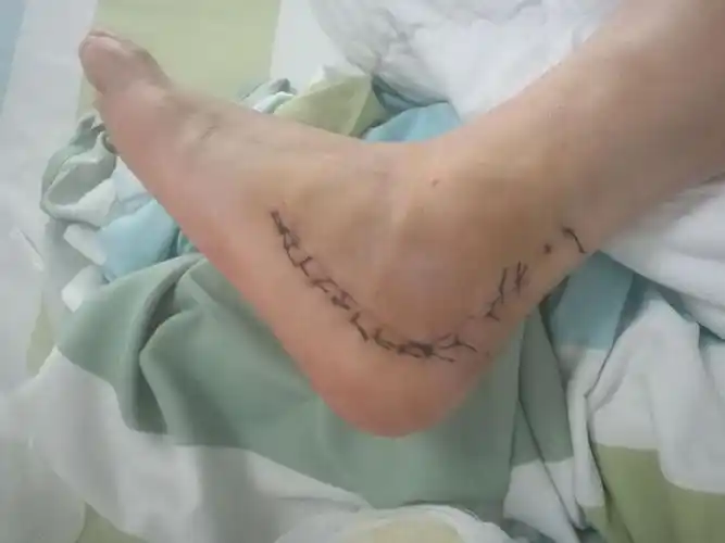 跟骨骨折扩大l切口切开复位内固定