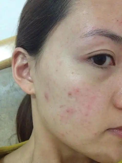 脸上起痘痘吃连翘败毒丸管用吗?