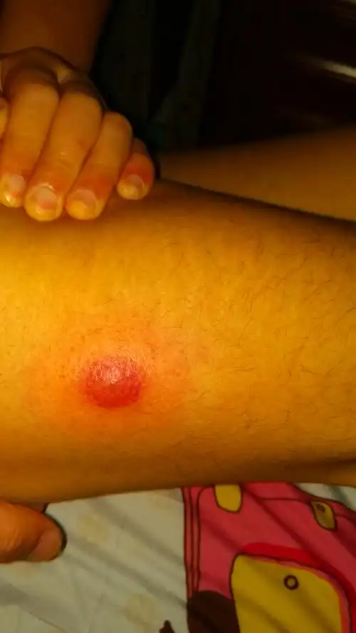 你好我的大腿外侧起了个肿包不碰有点痒一碰有点疼好几天了