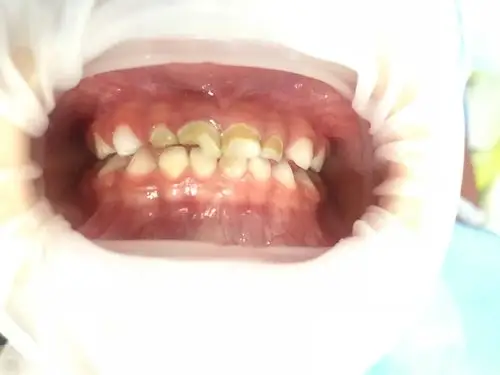 如何避免奶瓶龋? - 好大夫在线