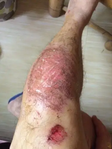 左边小腿昨天骑摩托车在碎石头地擦伤,昨晚用双氧水和碘伏擦了…今天