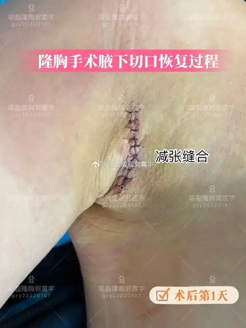 假体隆胸##复合隆胸##隆胸疤痕##隆胸手术