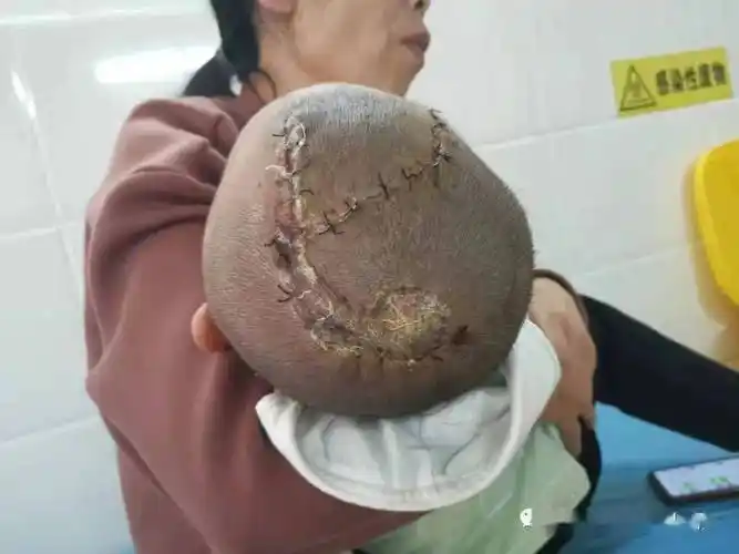 乾坤大挪移2岁女孩遇车祸头皮磨损仁福医院成功完成皮瓣转移术