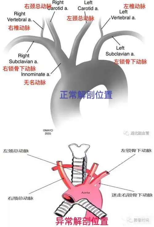 解剖变异!两例复杂主动脉夹层的手术治疗