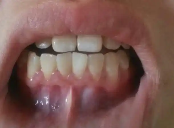 牙齿刷牙总是出血 ,图片上,我是不是下面一排牙的牙龈都萎缩了