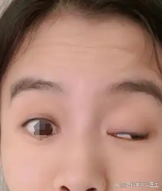 眼睛上睑下垂难睁开是什么原因?