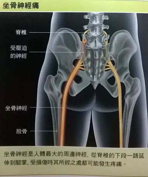 坐骨神经痛