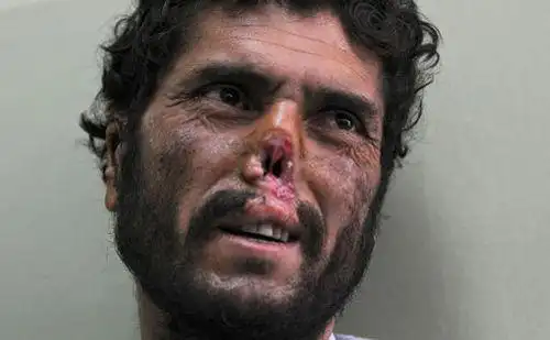 阿富汗选民因积极投票遭塔利班割掉耳鼻(组图)