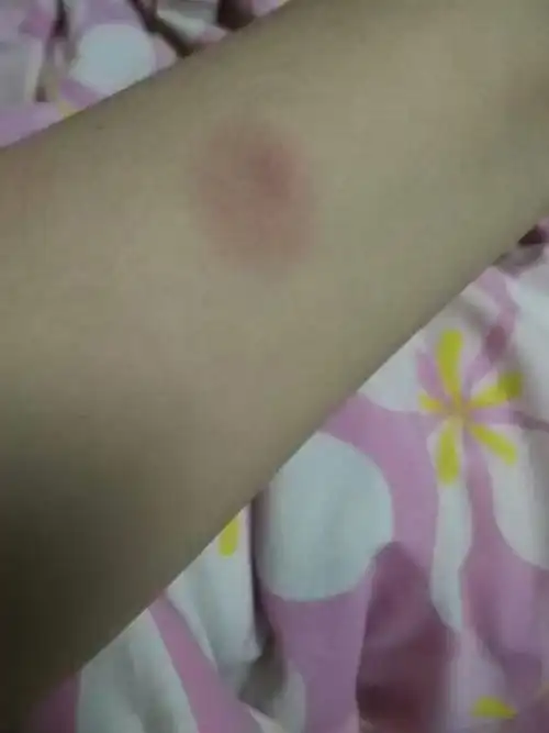 肺结核今天上午十点多做的ppd皮试有肿块不会又肺结核吧求回