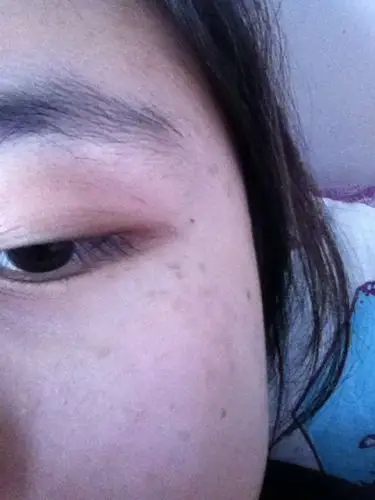 两边眼角都有这样的斑 这是什么斑 怎么去除