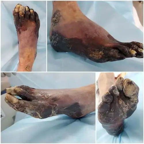 8床 关素华 女 65岁 病情平稳 今日换药足部干性坏疽,暂无皮下波动