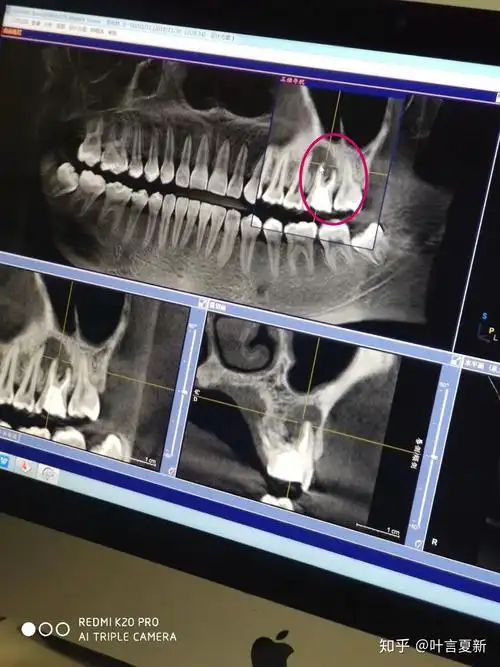 我的牙齿片子已经拍了,医生说有一个大的囊肿,请教,怎么办? - 知乎