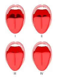grade i-soft palate, uvula, fauces, & pillars visible