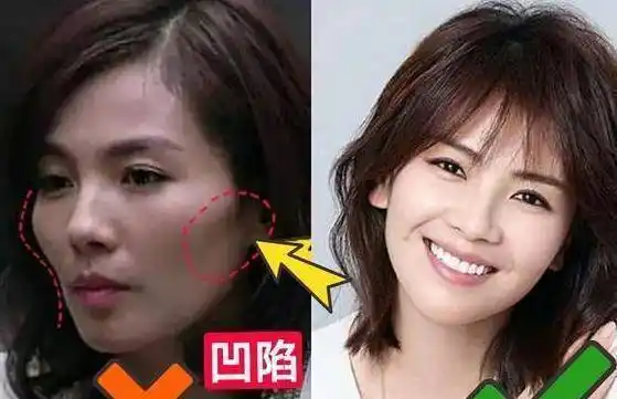 面部凹陷既显老,又拉低颜值,普通人要怎么补救?整形医生有话说